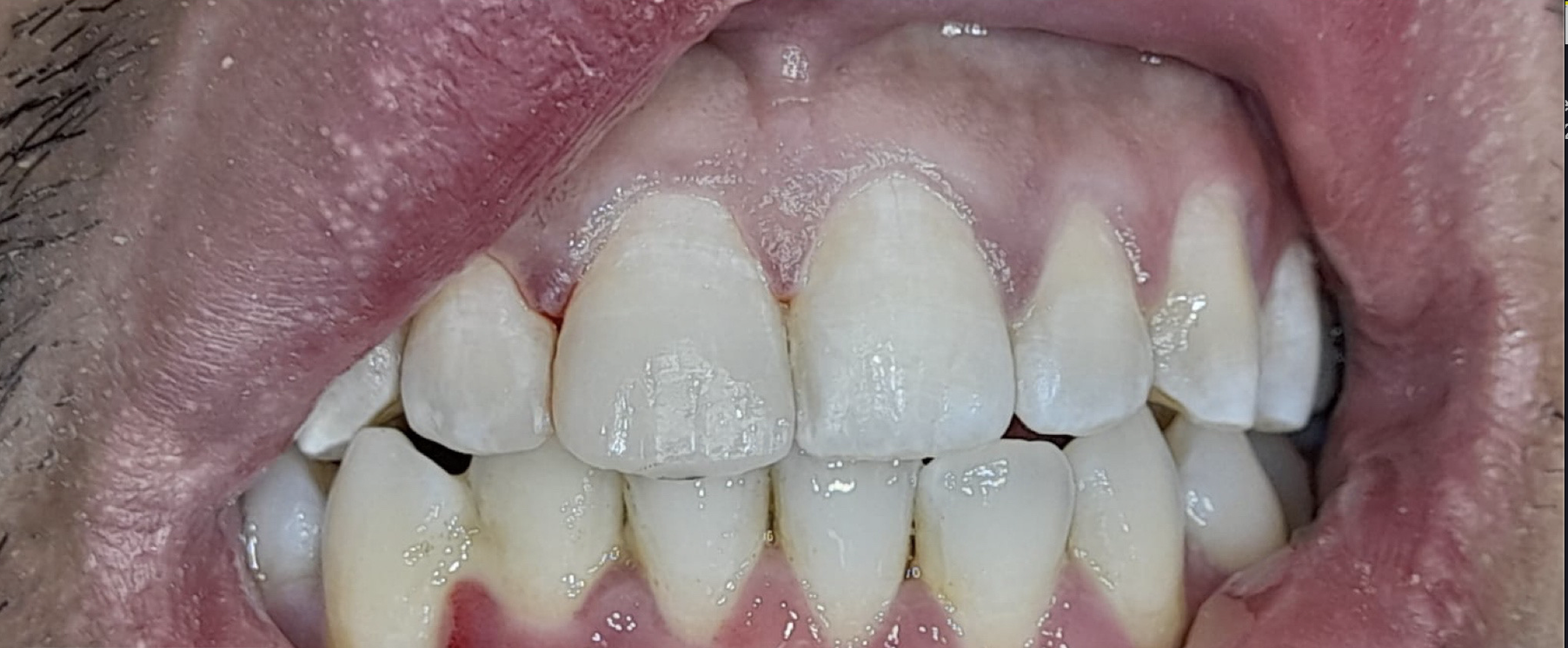 After Restoring a Chipped Front Tooth - dental transformation result