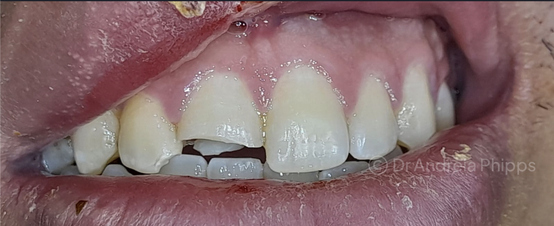 Before Restoring a Chipped Front Tooth - patient presentation