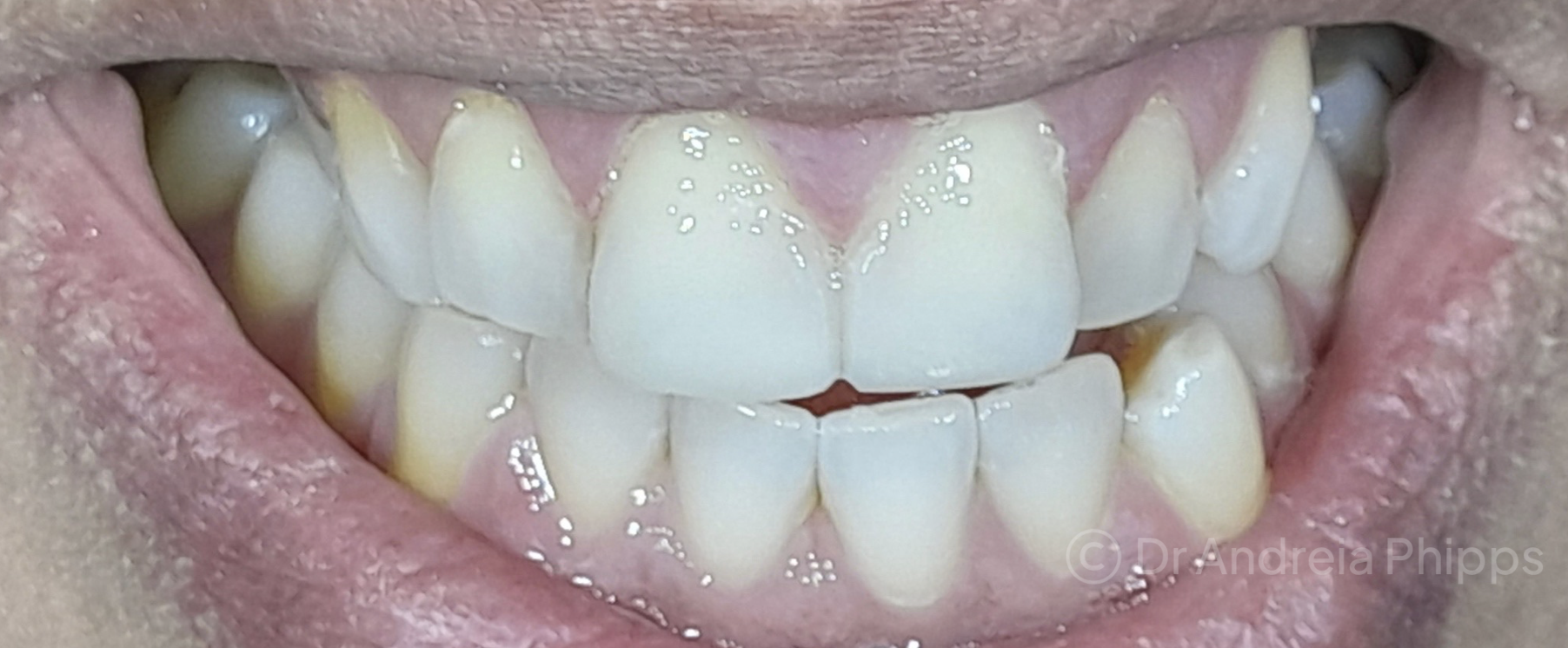 After Transforming Discoloured & Chipped Teeth - dental transformation result