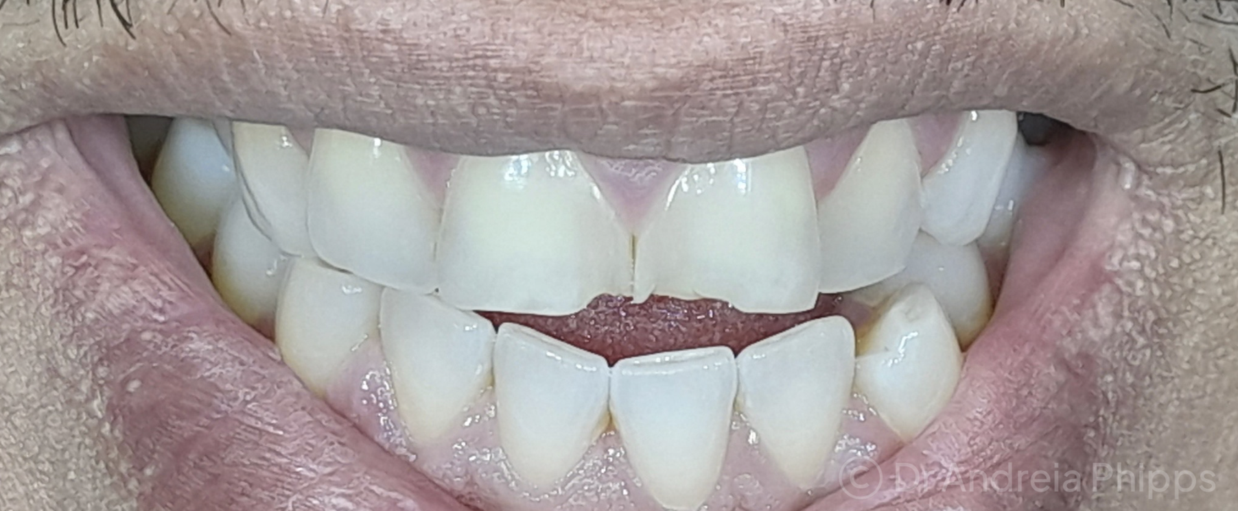Before Transforming Discoloured & Chipped Teeth - patient presentation