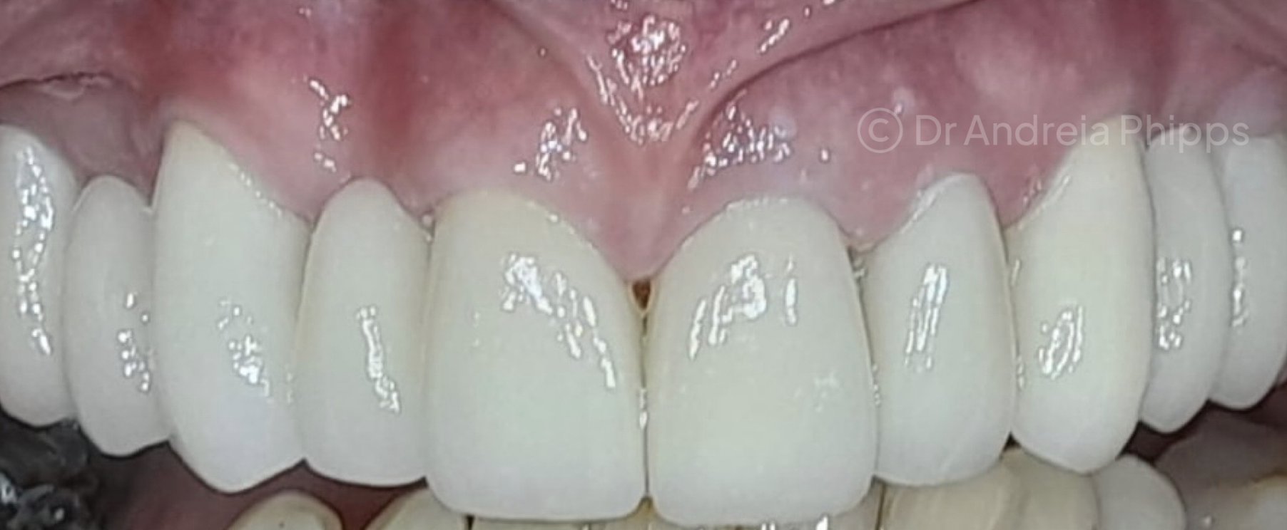 After Full Smile Rejuvenation: Veneers & Crowns - successful dental treatment result