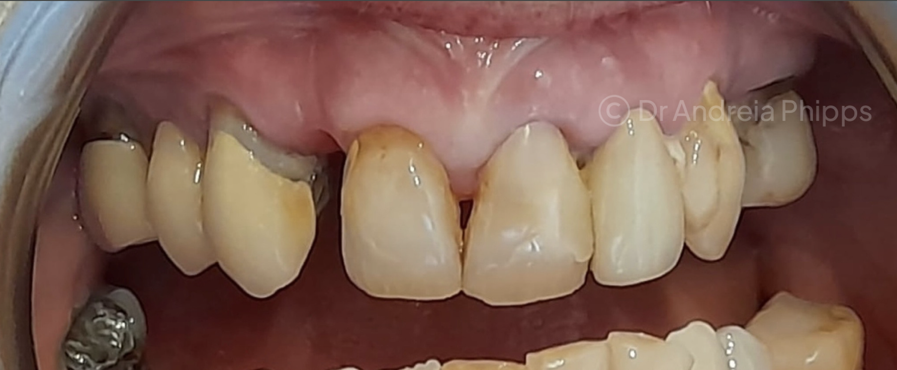 Before Full Smile Rejuvenation: Veneers & Crowns - patient presentation before treatment