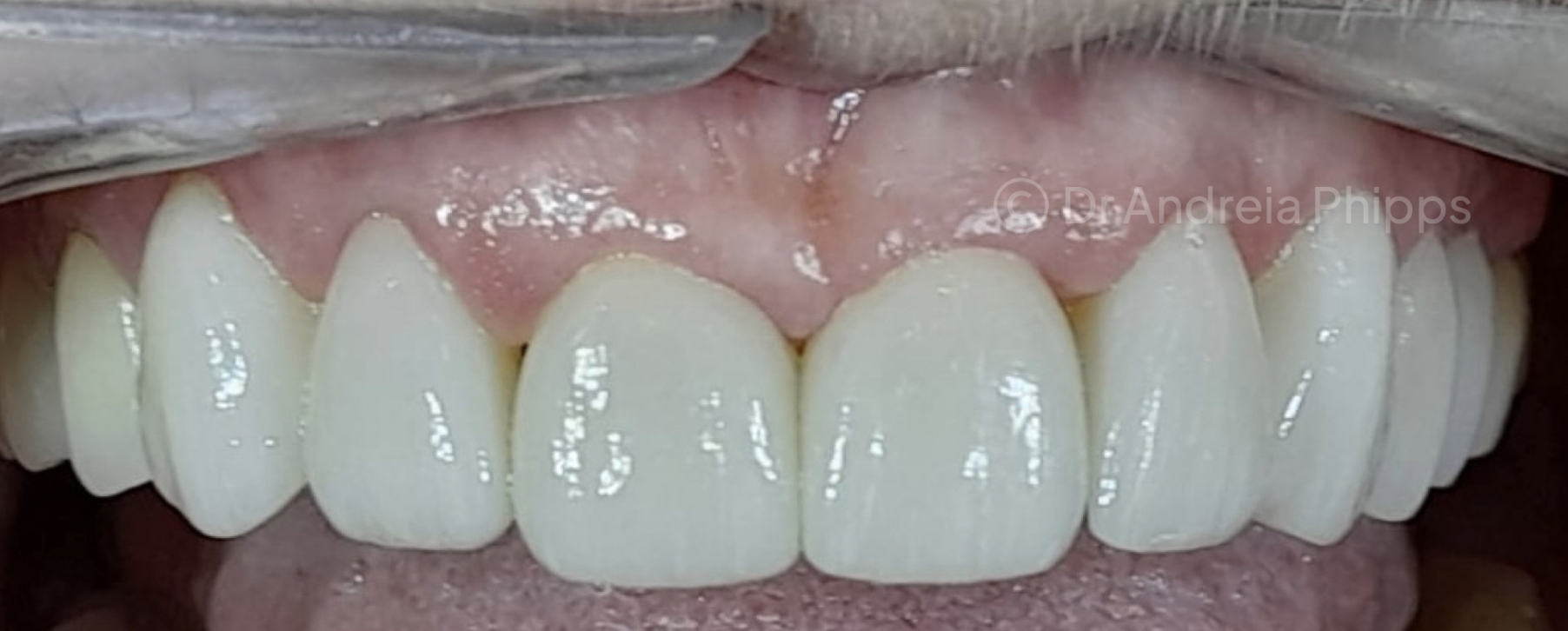 After Full Smile Transformation with 20 Veneers - successful dental treatment result
