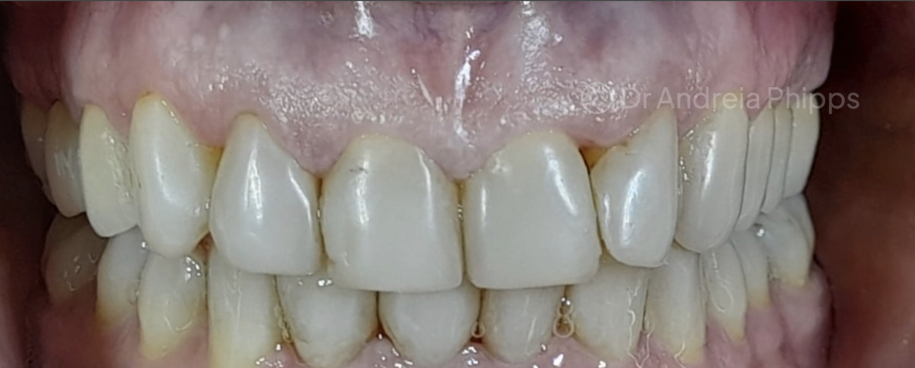 Before Full Smile Transformation with 20 Veneers - patient presentation before treatment