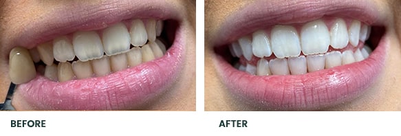 Teeth Whitening Before After 12