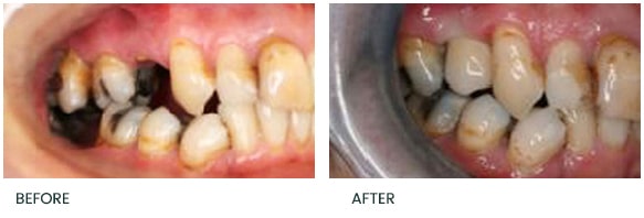 Immediate replacement of a upper right 2nd premolar tooth