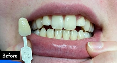 Teeth Whitening Before 10