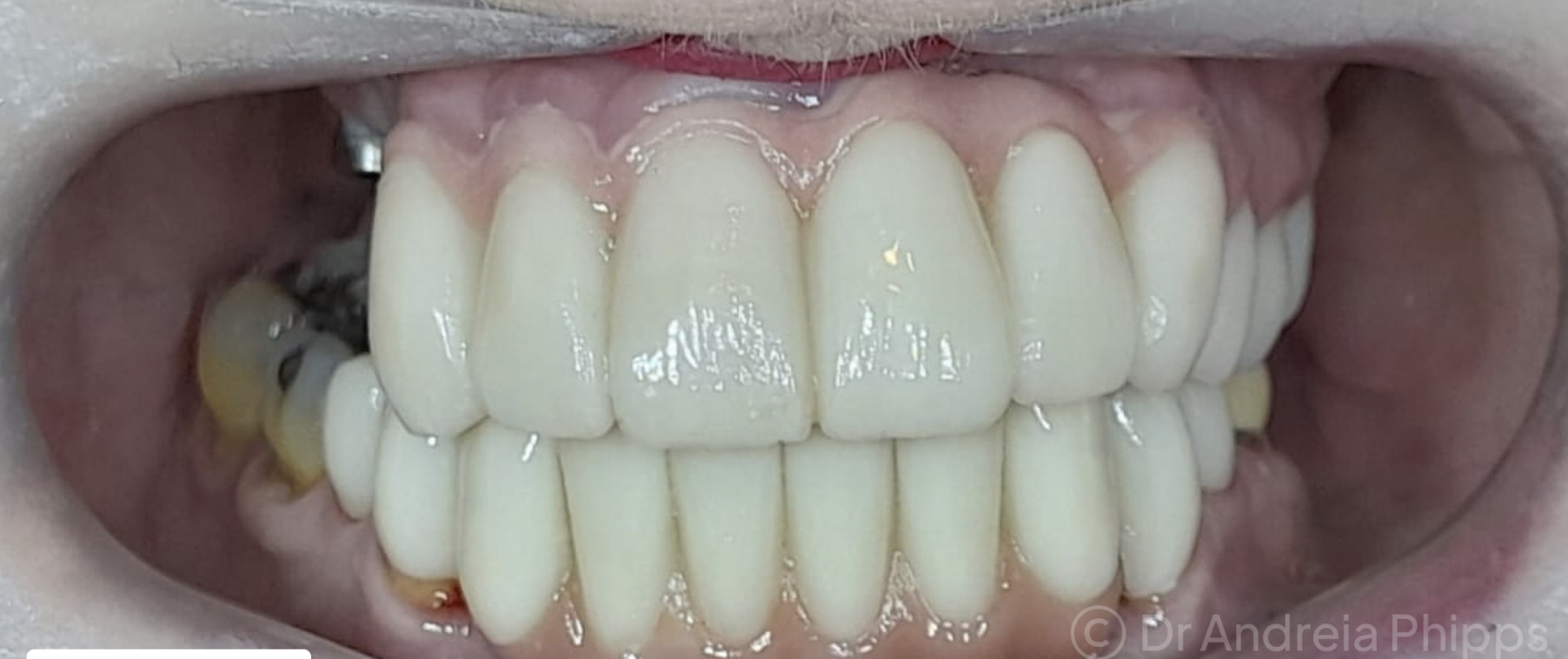 After Whitening and Aesthetic Restorations - successful dental treatment result