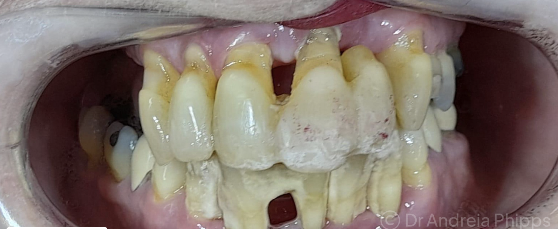 Before Whitening and Aesthetic Restorations - patient presentation before treatment