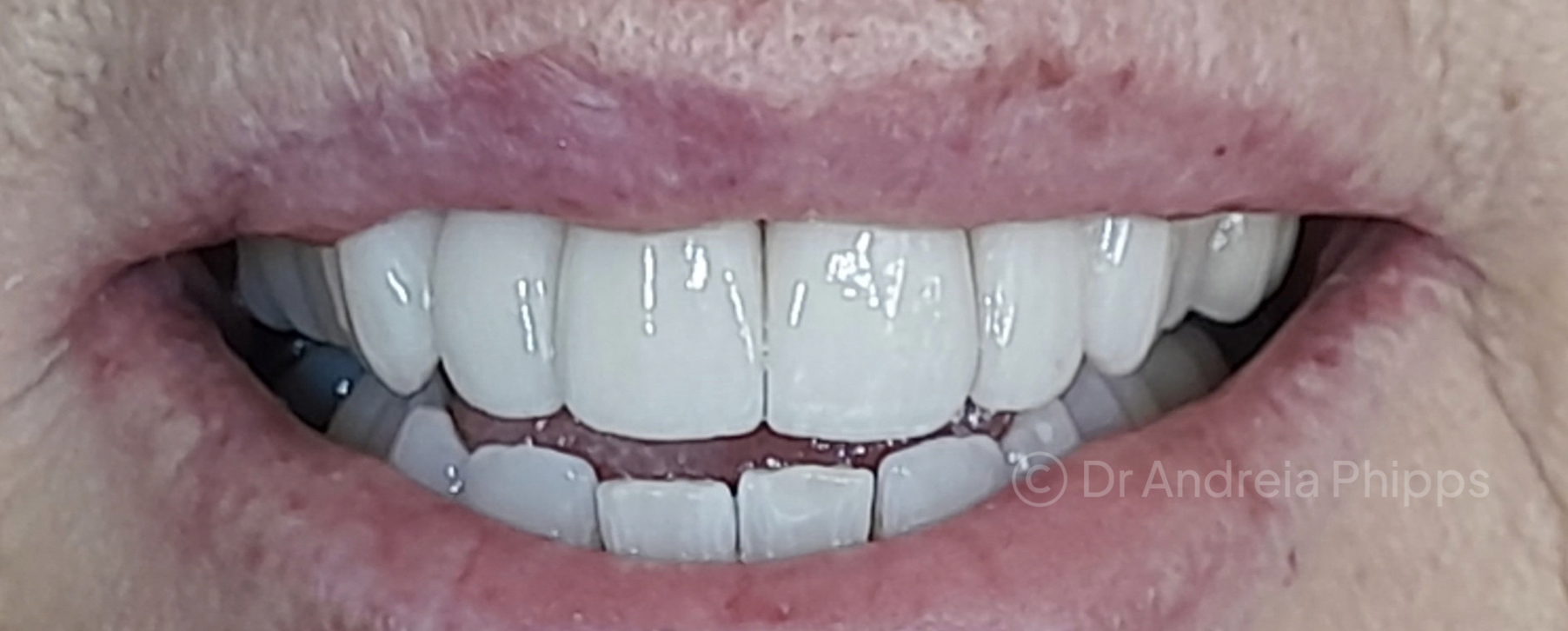 After Life-Changing Transformation: Whitening & Veneers - successful dental treatment result