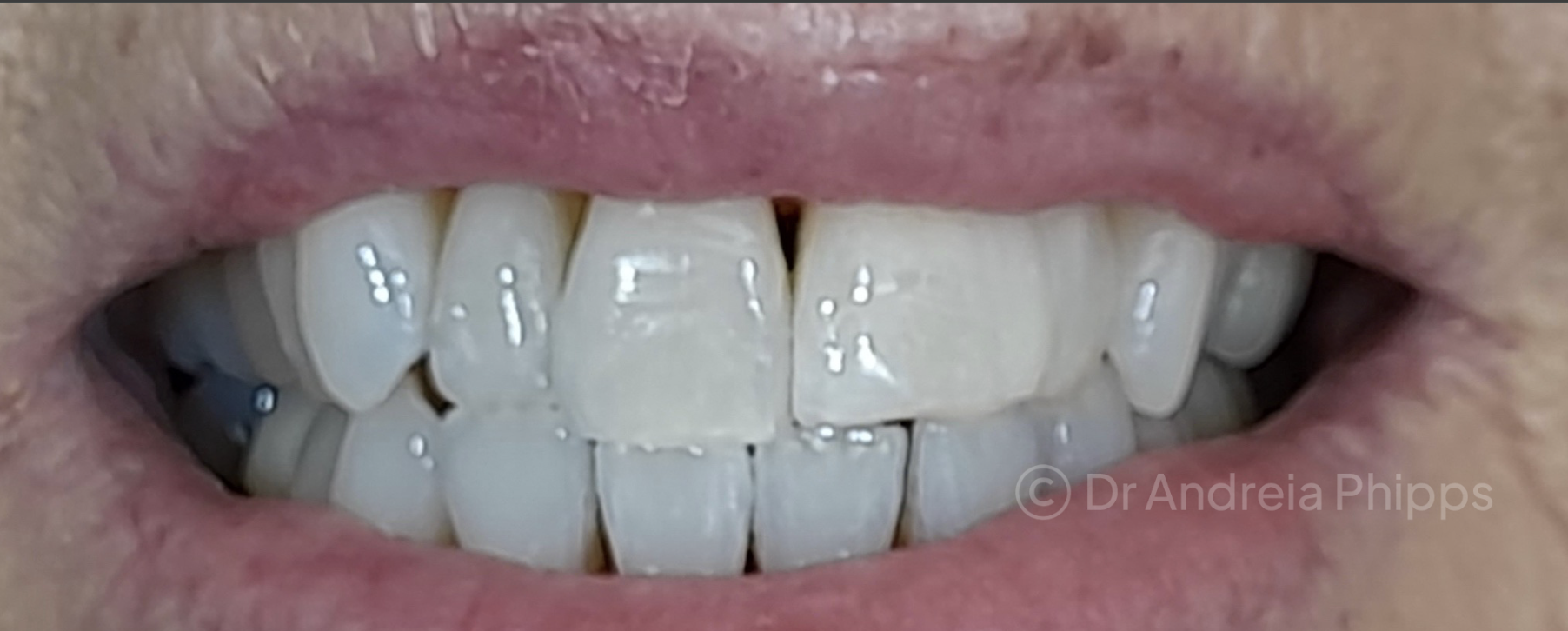 Before Life-Changing Transformation: Whitening & Veneers - patient presentation before treatment