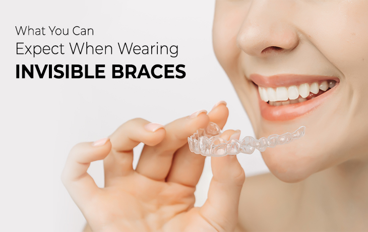 What You Can Expect When Wearing Invisible Braces